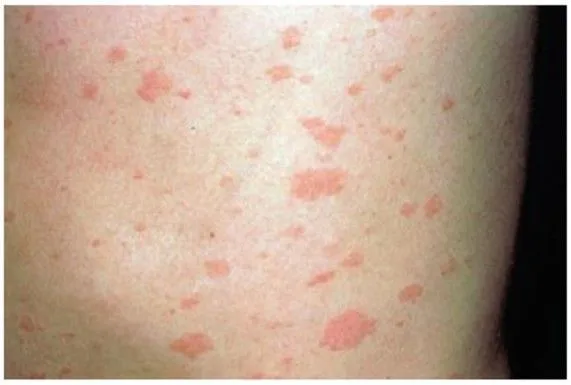 Figure 1. Erythematous maculopapular rash without distinct margins caused by Ehrlichiosis.